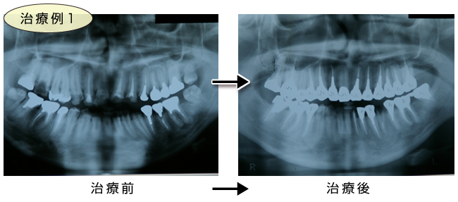 治療例1